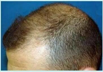 Antes