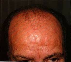 Antes