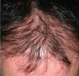 Antes